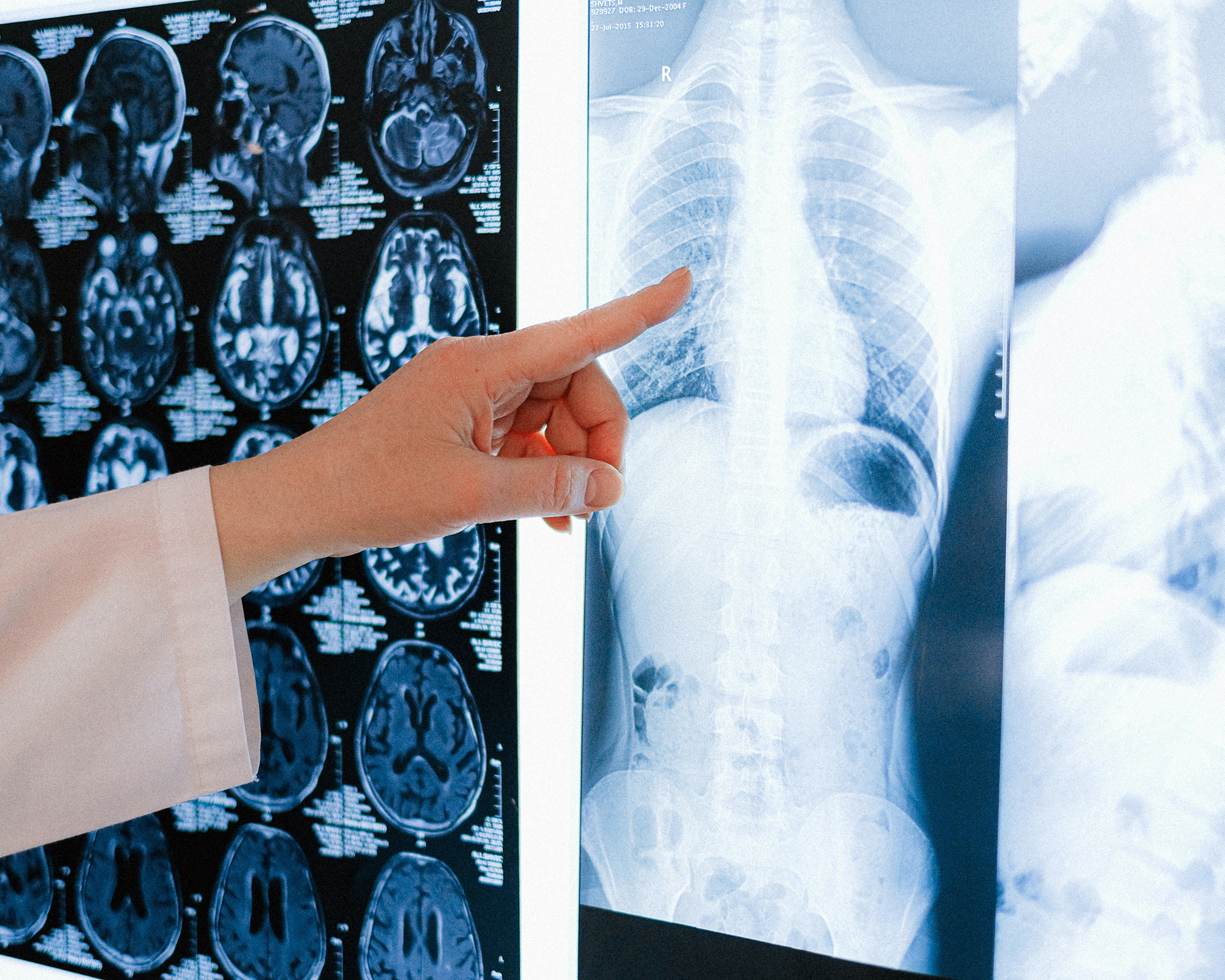 Doctor wearing a white coat pointing to a spinal x-ray - Spitzer Legal Serious Injury Practice Area